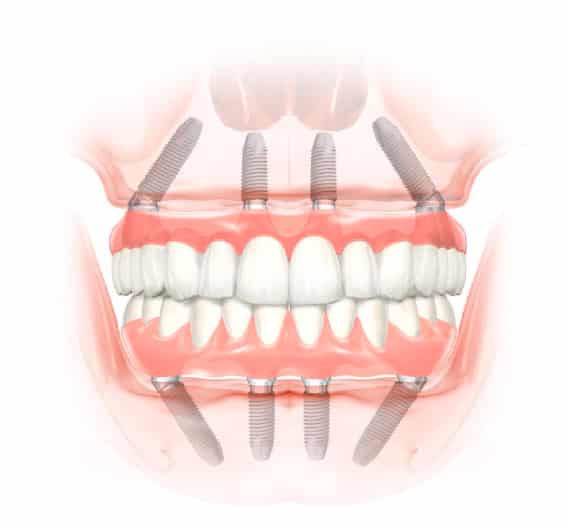 all-on-4 dental implants in fort worth tx