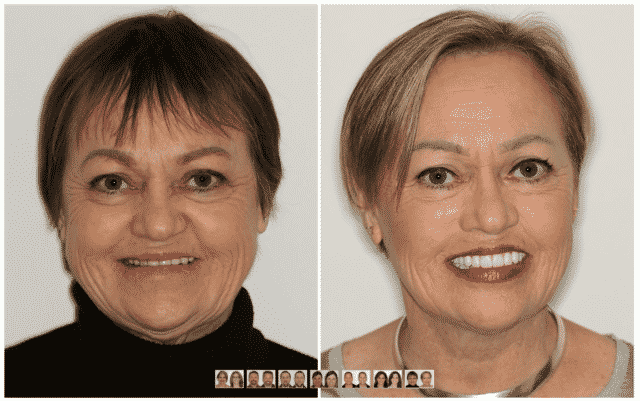 female implant patient before and after