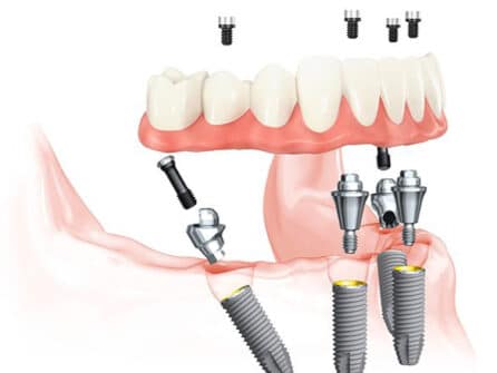 all-on-4 dental implants dallas fort worth
