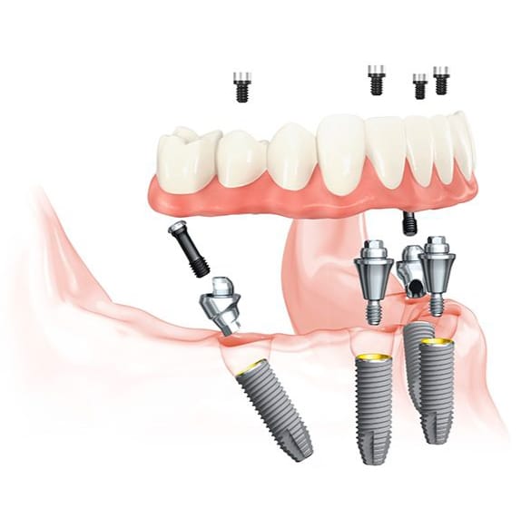 all-on-4 dental implants dallas fort worth