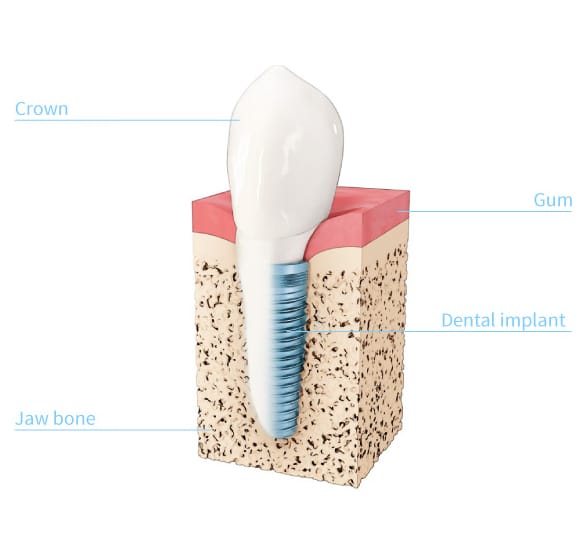 Dental Implant Dallas