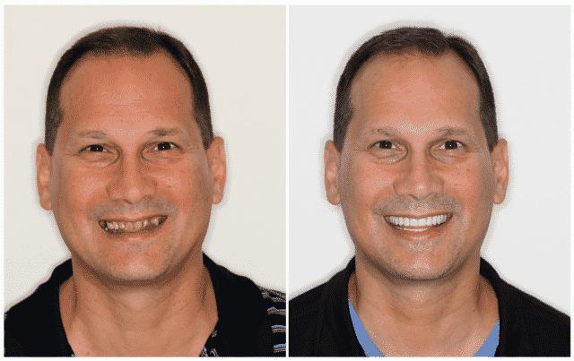 Paul's ARCHPOINT Smile Transformation