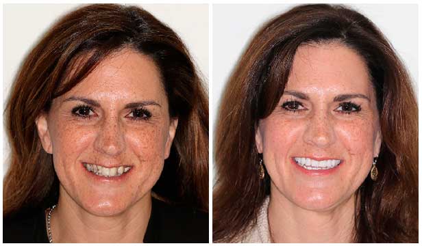 Jane's ARCHPOINT Dental Implant Transformation