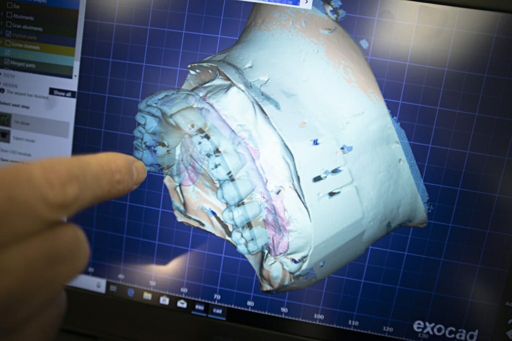 dental implant 3d scan