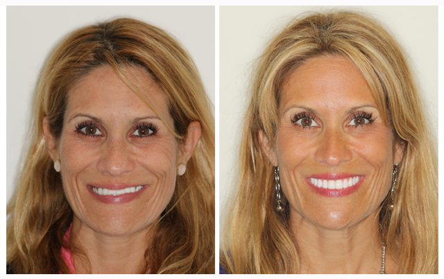 snap on denture results fort worth