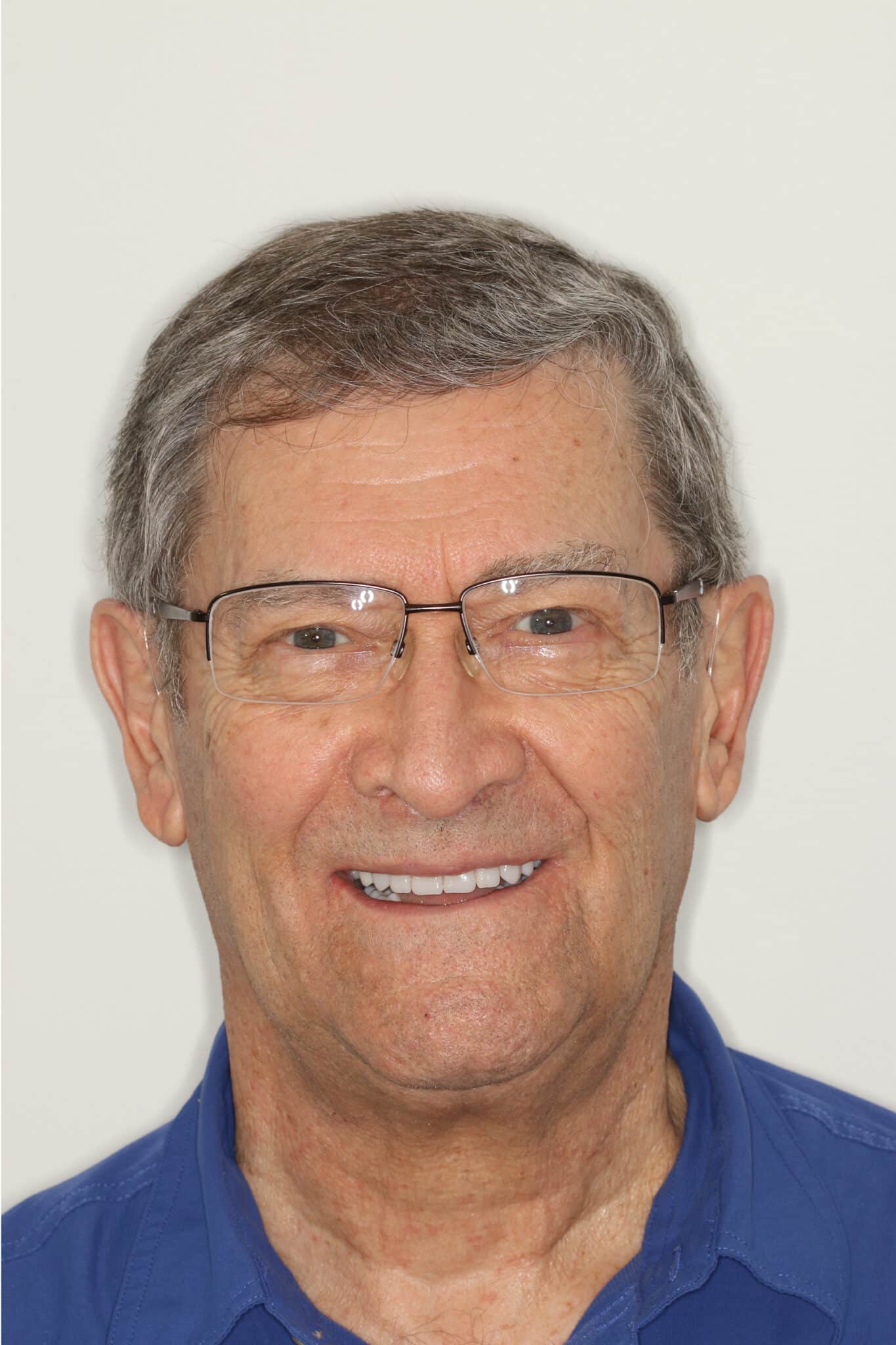 dental implant patient after picture bob