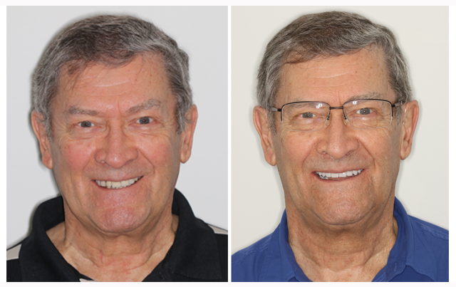 dental implants results fort worth