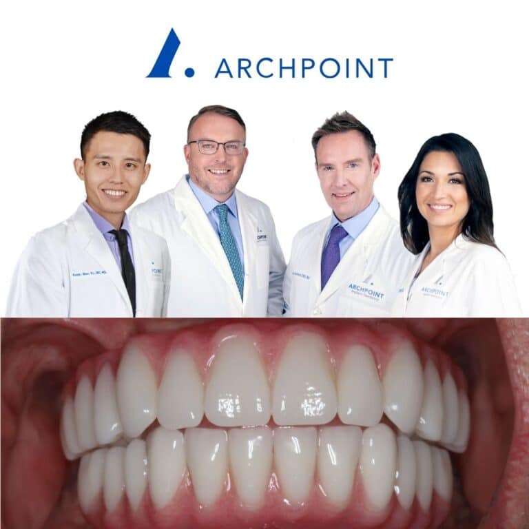 Allon4 Dental Implants in DFW ARCHPOINT Implant Dentistry