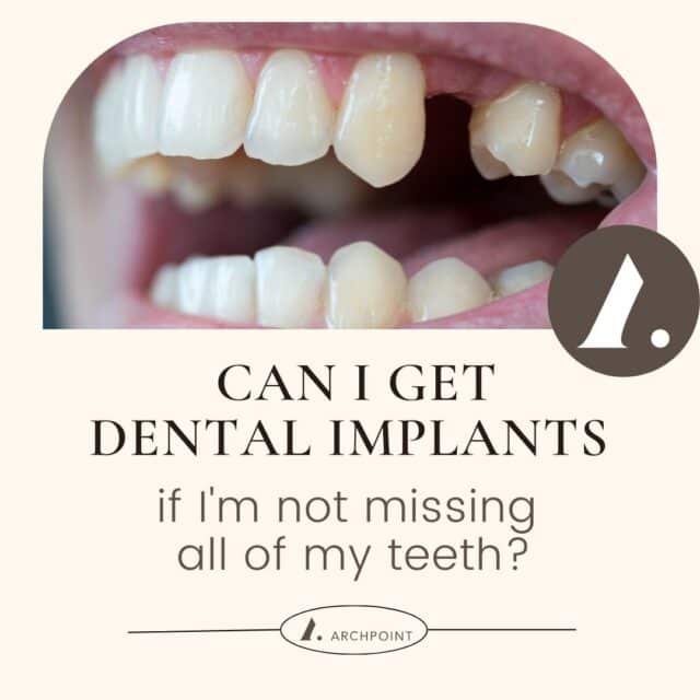 dental implants if not missing all of your teeth