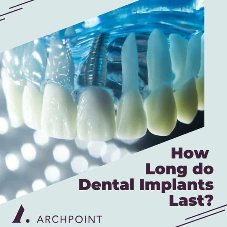 How Long do Dental Implants Last?