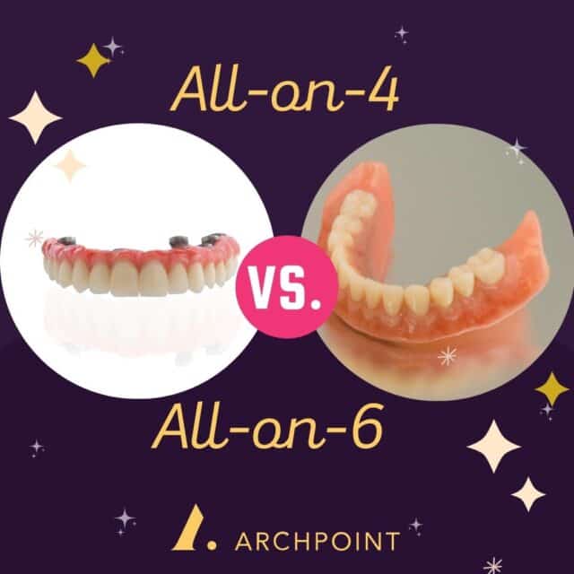 All-on-Four vs All-on-Six