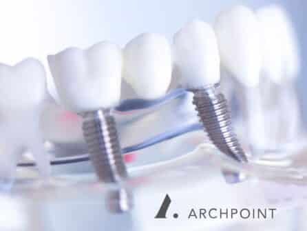 DFW implant bridges