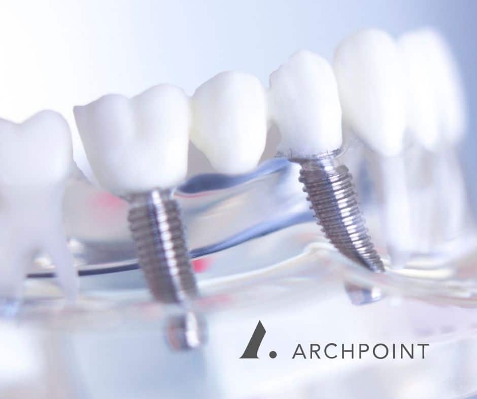 DFW implant bridges