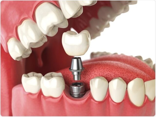 dental implants in dallas and fort worth