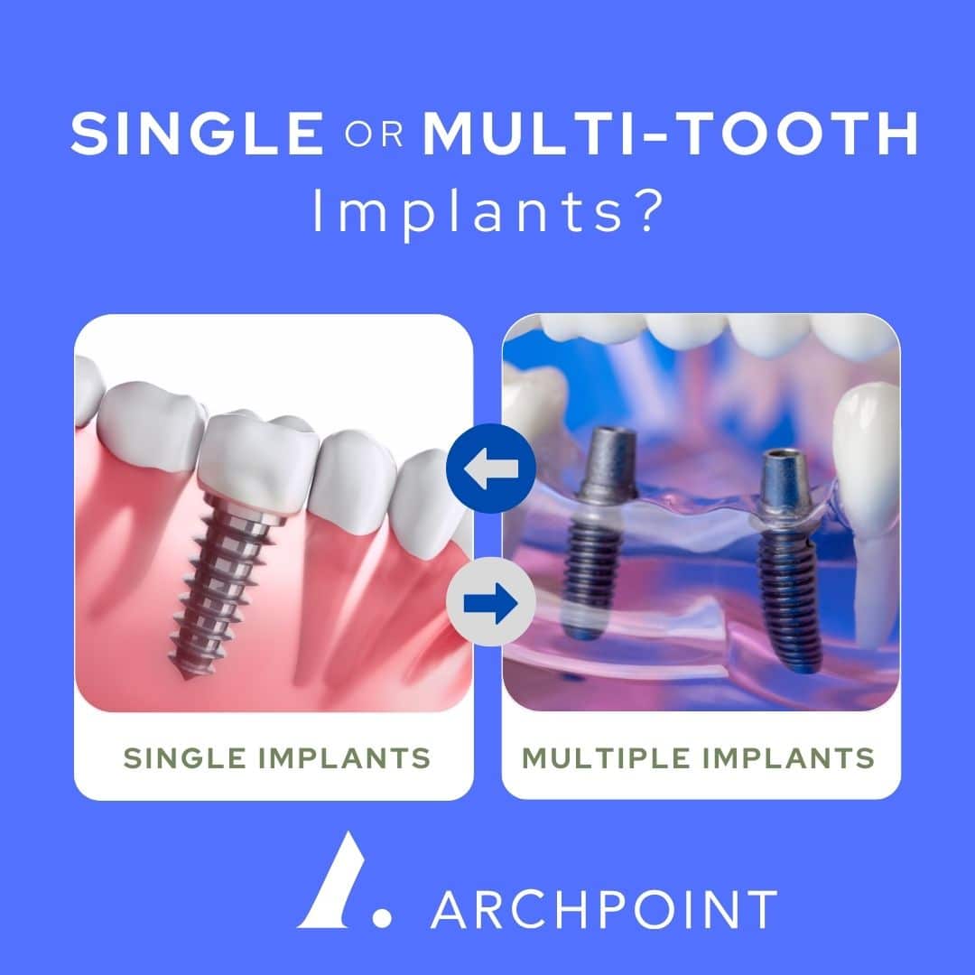 single or multi-tooth implants
