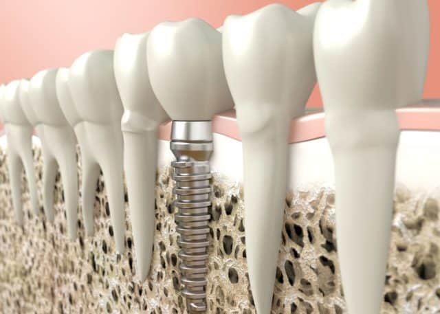 single tooth types of dental implants in fort worth tx