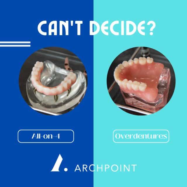 overdentures vs. all-on-4