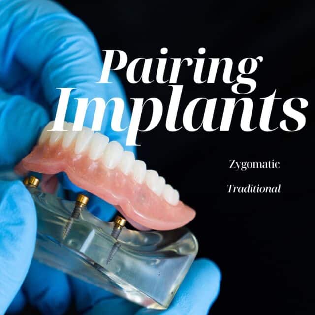 zygomatic implants in DFW