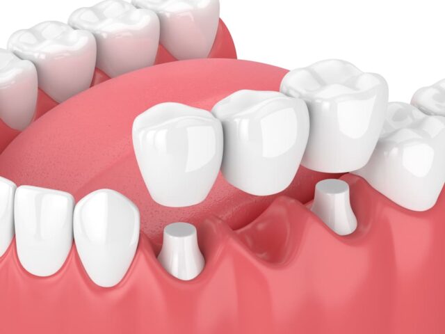 ceramic detnal implants