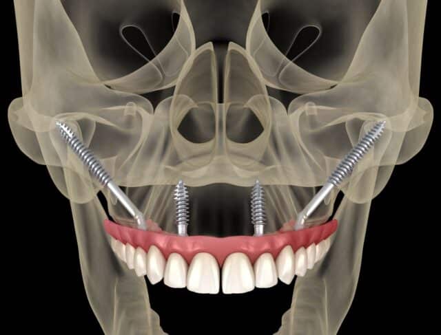 Zygomatic Implants in fort worth tx