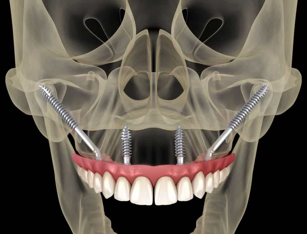 Implant dentist near me Implants dental