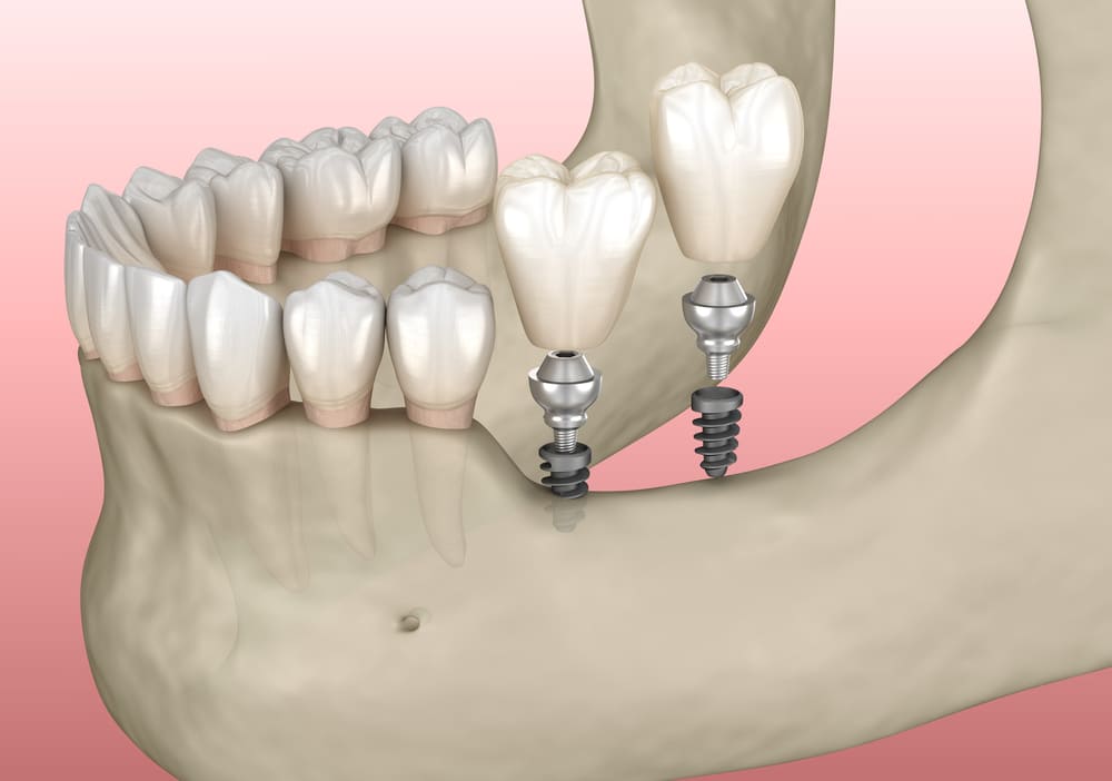Implant dentist near me Implants dental