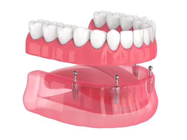 snap on dentures in fort worth tx