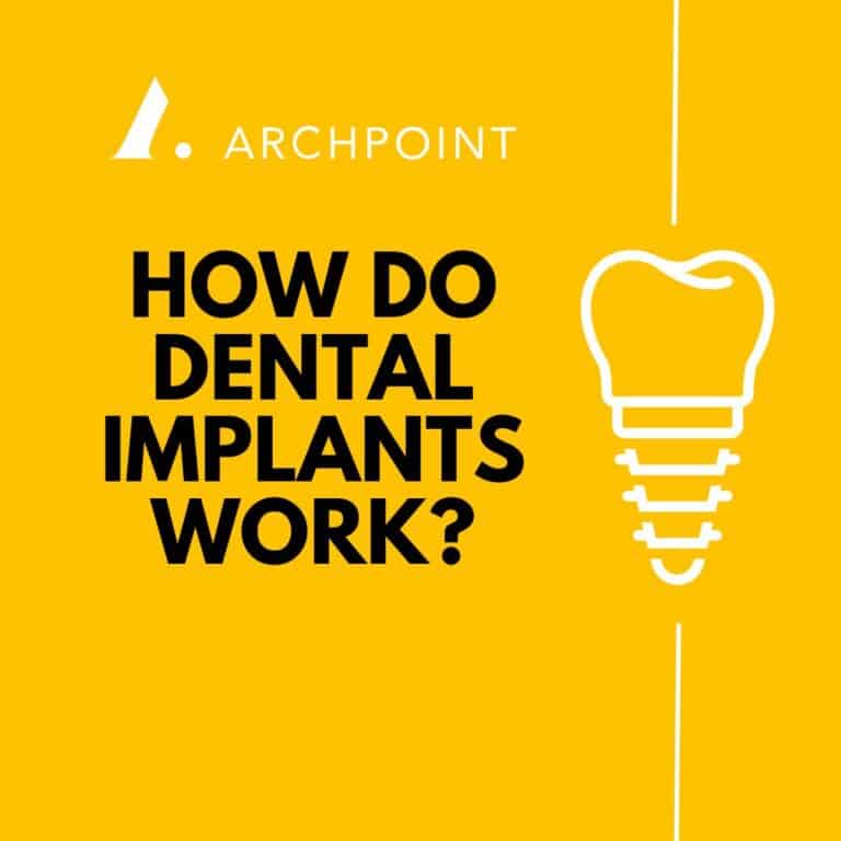 How Do Dental Implants Work? ARCHPOINT Implant Dentistry