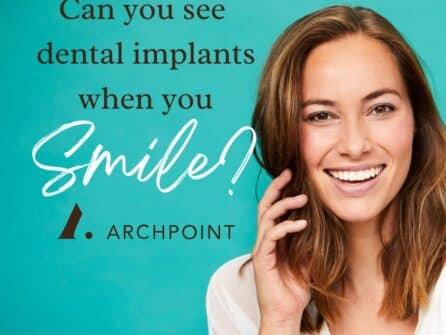Are dental implants visible when you smile