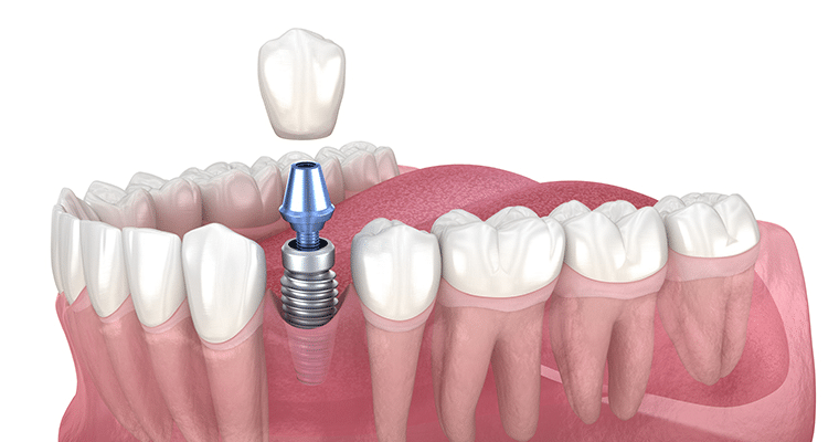 titatnium dental implants
