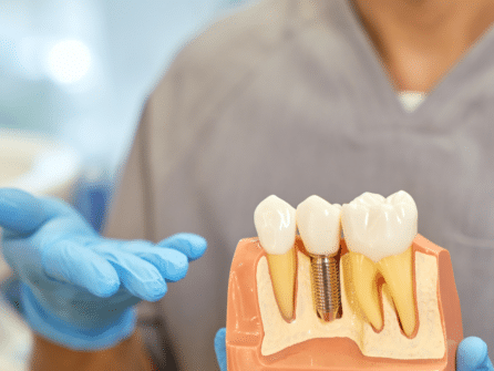implants dental