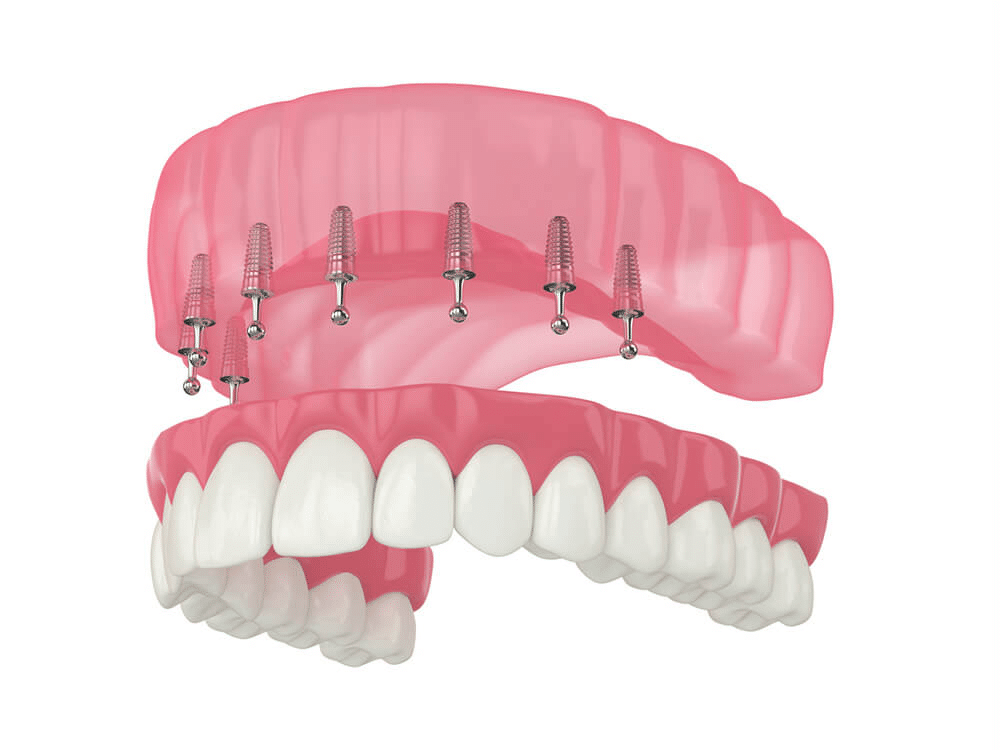 dental implants