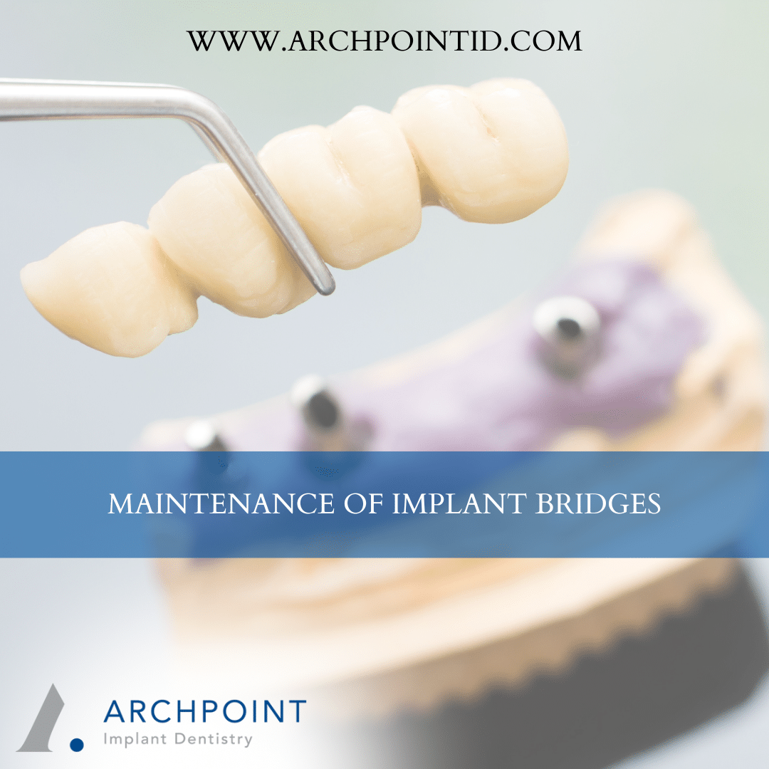 Implant Bridges