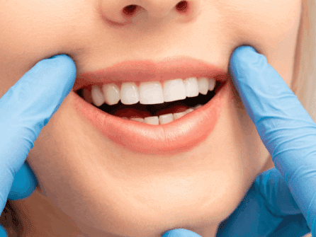 Dental Implant